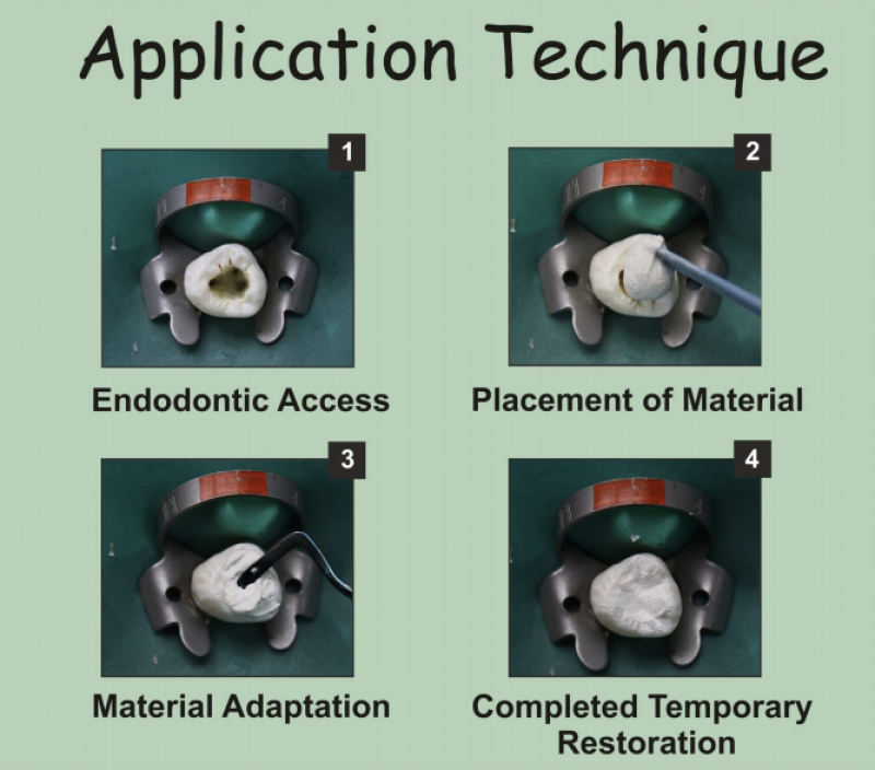 Temporary Filling Materials Archives - Access Dental